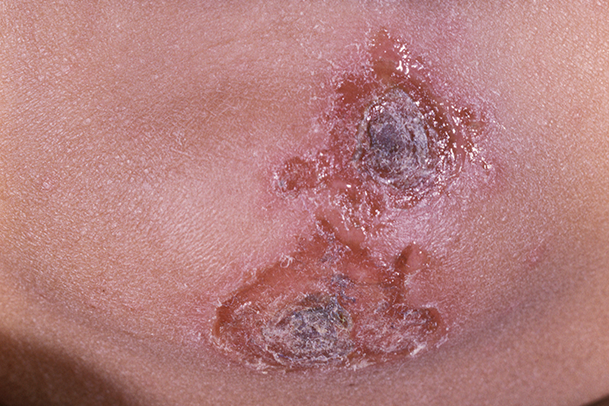 Sinusitis Treatment Image